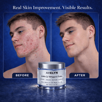 AVELYN GHK-CU Whipped Balm – Advanced Acne & Skin Repair
